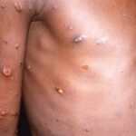 Alerta en el Valle por el primer caso registrado de Monkeypox