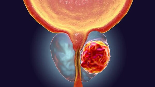 Cáncer de próstata una enfermedad silenciosa y más común de lo que parece 