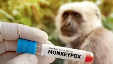 Cuatro casos sospechosos de viruela del mono en Santander
