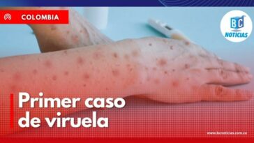 Se confirma el primer caso de viruela símica en Manizales