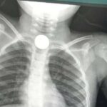 Un niño se traga dos monedas y su familia denuncia no atención médica