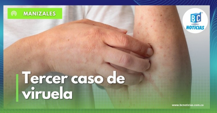 Se reporta el tercer caso de viruela Símica en Caldas