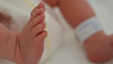 En Barranquilla nació bebé que habían separado de su gemelo con malformación