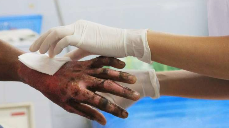 Niño de 6 años con quemadura de primer grado en la cara y daño ocular por volador