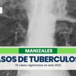 76 casos de tuberculosis se han registrado en Manizales en este 2023