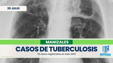 76 casos de tuberculosis se han registrado en Manizales en este 2023