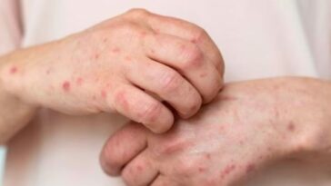 Con más de 100 casos, los hombres son los más afectados por la varicela individual en el Quindío