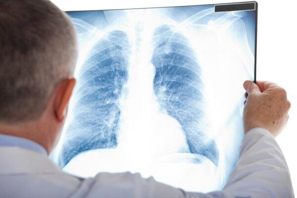 El tabaquismo: la principal causa de cáncer de pulmón y EPOC