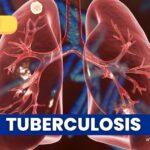 23 casos de tuberculosis se han registrado este año en Caldas
