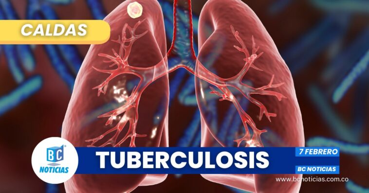 23 casos de tuberculosis se han registrado este año en Caldas