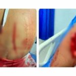 Dos mujeres heridas con pico de botella en riña