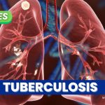 156 casos de tuberculosis se han registrado en las cárceles de Manizales